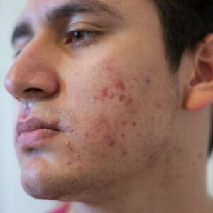 traitement efficace contre l'acné sévère 