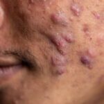 malformations graves du à l'acné 