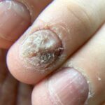psoriasis sur ongle 