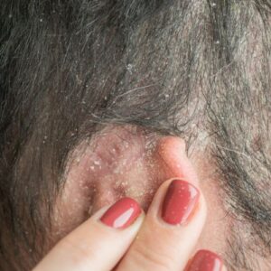 symptômes du psoriasis perte cheveux 