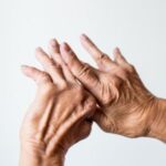 Psoriasis arthritique ou rhumatisme psoriasique en photo