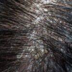 psoriasis dans les cheveux en photo