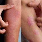 psoriasis et eczema les différences d'aspect en photo