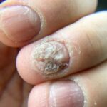 psoriasis de l'ongle en photo