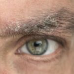 psoriasis dans les sourcils sur le visage en photo