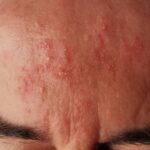 acné rosacée palpule forme grave