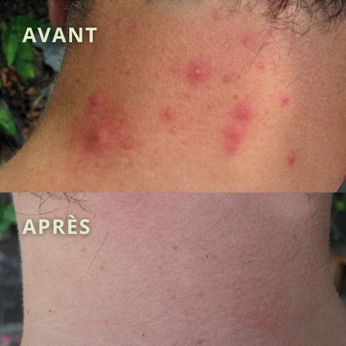 acne cou avant après temoignage