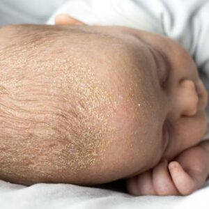 croûtes cuir chevelu cheveux bébé nourisson