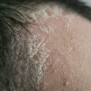 croutes cuir chevelu psoriasis