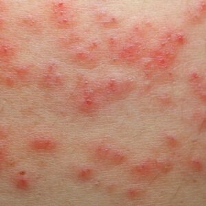 eczema grosesse symptômes rougeurs et plaques